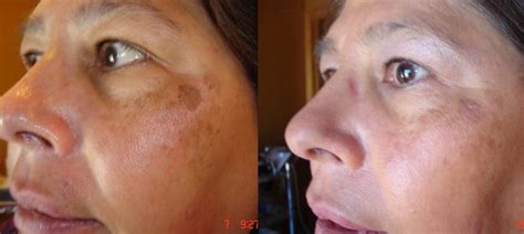 Rnfaces Skin Classic Acne Care Laguna Niguel Not Just Faces Medical