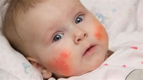 Random skin rashes are not due to food allergy. How to know if your child might be at risk for food ...