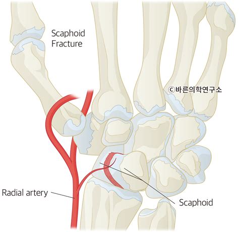 주상골 골절 Scaphoid Fracture Metamedic