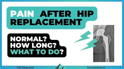 Thigh Pain After Hip Replacement Treatment Recovery Time