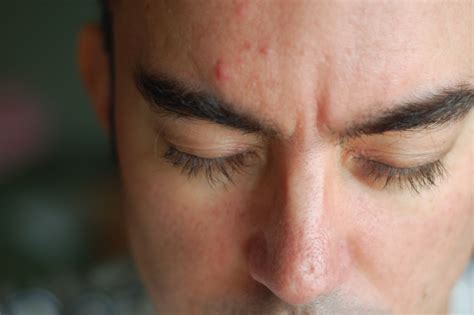 How To Get Rid Of Pimples On Forehead In One Day