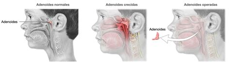 Adenoides Vocalia ® Dr Gerardo López Guerra Orl Y Ccc