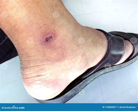 Lesion Scab Dried On The Epidermis Skin Ankle Lesion Dermatitis Dark