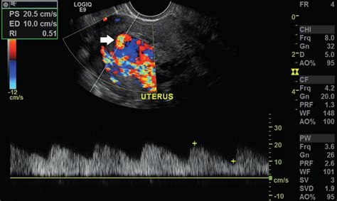 Transvaginal Ultrasound In Sagittal A And Axial B Planes Showing