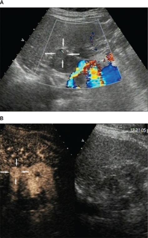 Renal Oncocytoma Wu 2013 Journal Of Ultrasound In Medicine