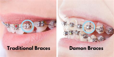 Damon Braces What Are They Benefits And Cost The Teeth Blog
