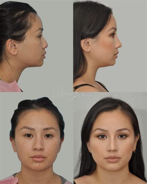A Great Example Of Organic Asian Rhinoplasty Charles S Lee Md