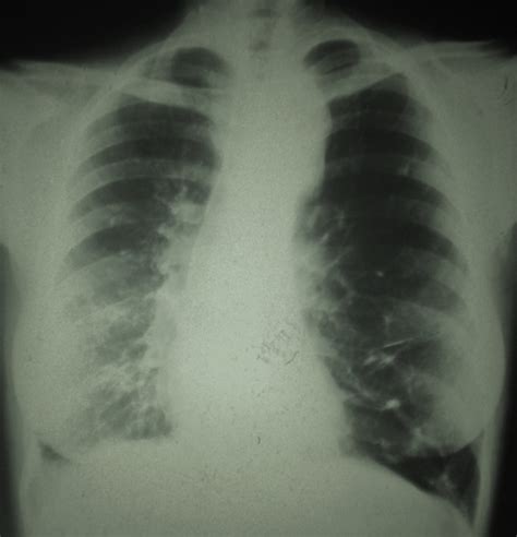 Archivo Imagen Radiografa PA De Trax En Inspiracin Hiperclaridad Pulmonar Izquierda