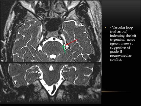 Figure 14 From Imaging In Neurovascular Conflict Of The Trigeminal