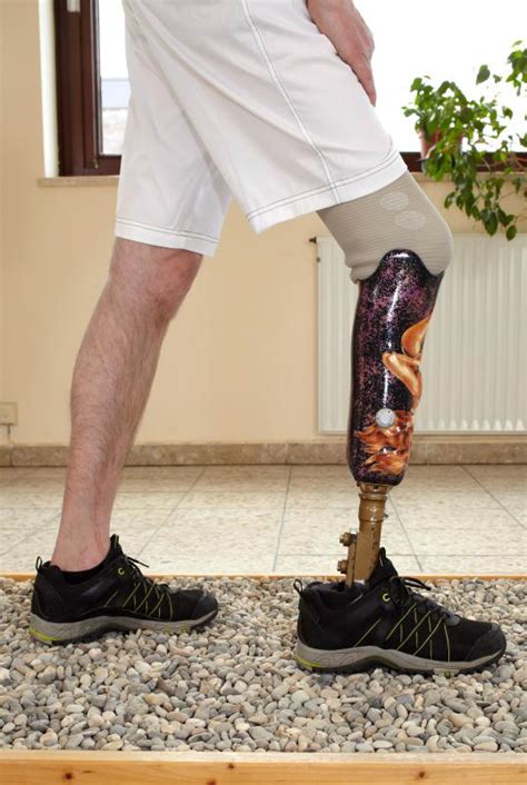 What Is A Prosthetic Leg With Pictures