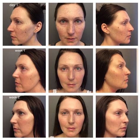 Ipl Results Ipl Photofacial Normal Skin Care Routine Proper Exfoliation