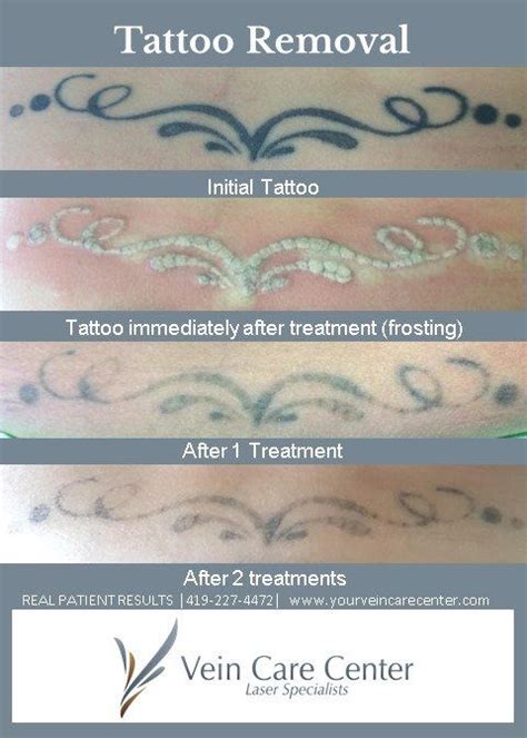 Laser Tattoo Removal Before And In Process Photos Tattoo Removal