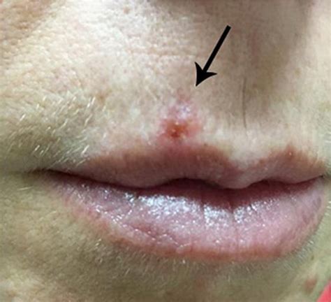 Figure 1 From Delayed Diagnosis Of Basal Cell Carcinoma Of The Upper