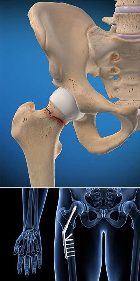 Hip Fracture Central Coast Orthopedic Medical Group