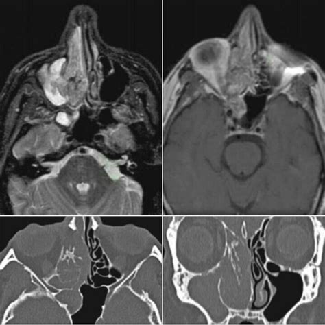 Large Polypoidal Expansile Mass Filling The Rt Nasal Cavity Dysmorphic