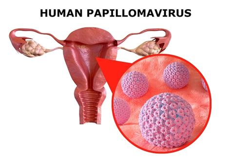 Human Papillomavirus HPV Patofisiologi Diagnosis Penatalaksanaan