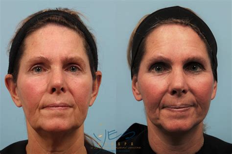 Face Lift Neck Lift Before After Photos Patient Vancouver Bc Hot Sex