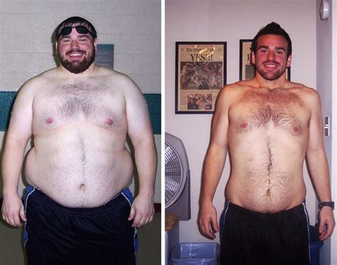Pictures Of Bariatric Surgery Before And After Before And After