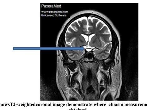 Figure 2 From Assessment Of Optic Chiasm Measurements In Abnormal MRI