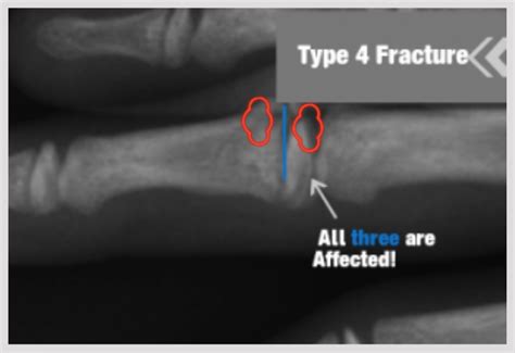 Growth Plate Fractures Part 2