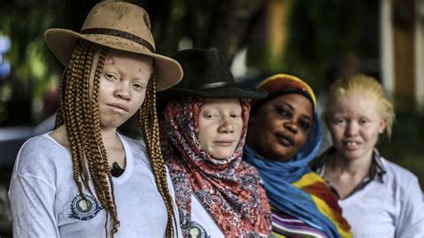 Aberglaube Albinos Werden In Malawi Wie Tiere Gejagt Welt