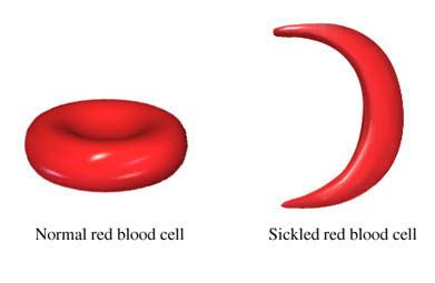 Sickle Cell Anemia; Normal Blood Cells to Sickled