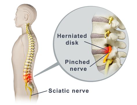 What Is A Pinched Nerve Cause And Symptoms Of A Pinched Nerve San