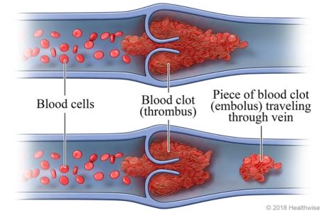 Trombosis vs Embolia Infografía Hot Sex Picture