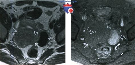 Лучевые признаки аденомиомы матки