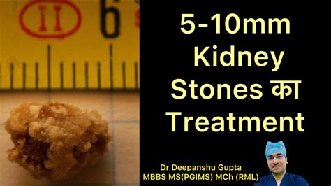 5 10mm Kidney Stone का इलाज कैसे होता है Treatment For 5 10 Mm Kidney