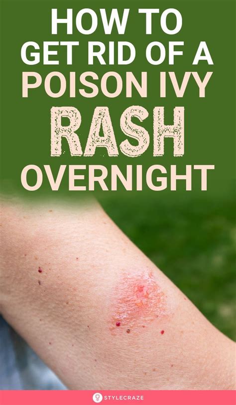 How To Get Rid Of A Poison Ivy Rash Overnight In Poison Ivy Rash How To Get Rid Poison Ivy