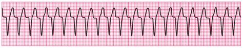 Taquicardia Ventricular Monomórfica CPTC Healthpoint