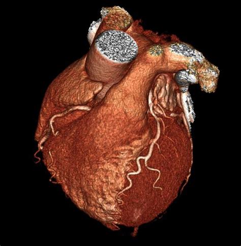 Coronary Ct Angiography Melbourne Heart Care