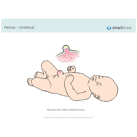Hernia Umbilical