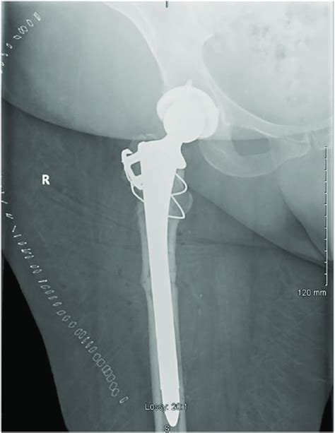 Anteroposterior X Ray Of Right Hip Post Total Hip Arthroplasty With