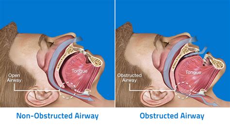 Sleep apnea is estimated that up to 13 per cent of men and 6 per cent of women suffer from obstructive sleep apnea.the condition often goes diagnosed but affects sleep quality, leaving people feeling tired the following day. Choose Sleep Apnea Doctor