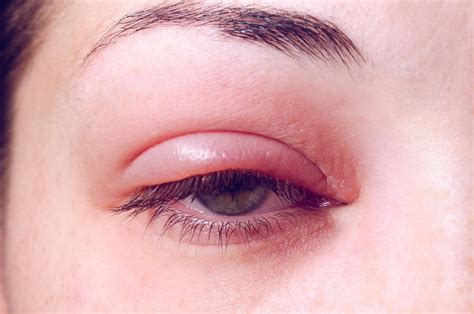 Swollen Eyelids Symptoms Diagnosis Treatment Rxharun