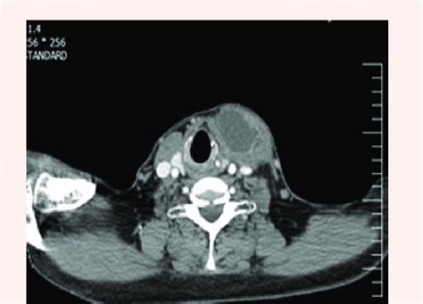 Ct Scan Of Neck Show A Cystic Lesion In Thyroid Figure 6 A