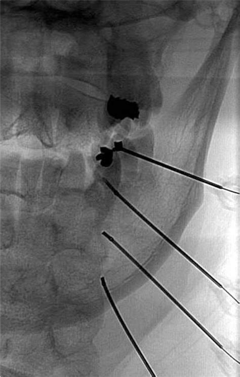 An Anteroposterior Radiograph Of Needle Placement For Third Occipital