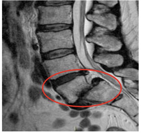 Pars Defect London Neurosurgery Spine And Neurosurgery
