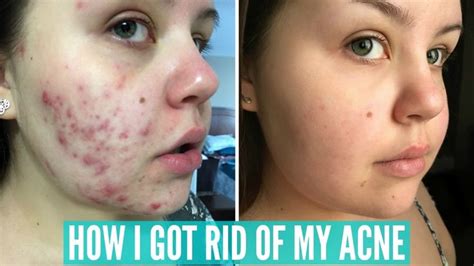 How I Cleared Up My Severe Acne Sarireanna Severe Acne Acne