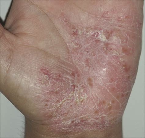 Leflunomide In The Treatment Of Palmoplantar Pustulosis Dermatology