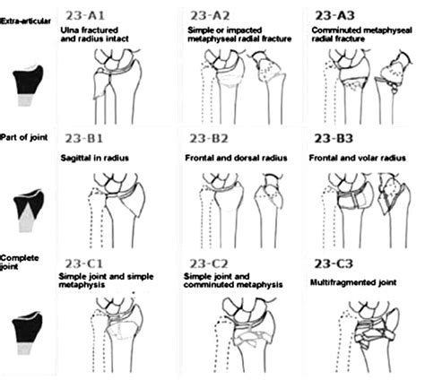 Ao Classification For The Fractures Of Distal Radius 5 Download