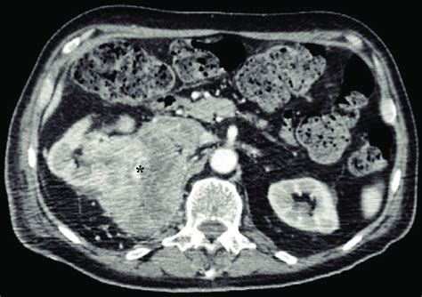 Axial Abdominal Contrast Enhanced Computed Tomography Scan Image