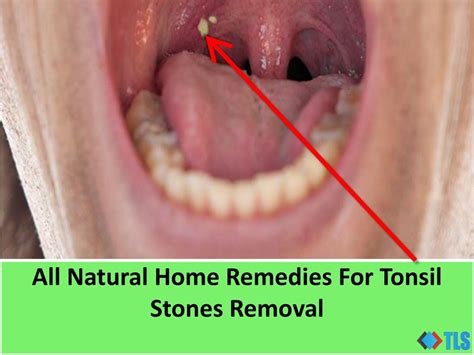 Ppt All Natural Home Remedies For Tonsil Stones Removal Powerpoint