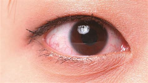 ¿cómo saber si tengo el síndrome del ojo seco síntomas causas y tratamiento
