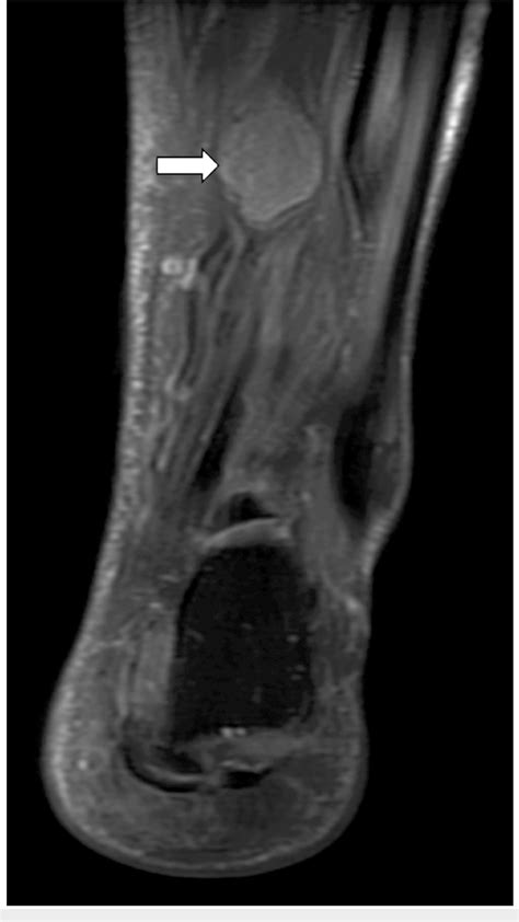 Figure 1 From Posterior Tibial Nerve Schwannoma Presenting As Tarsal