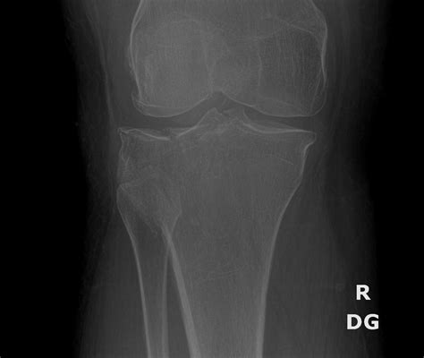 Orthodx Lateral Tibial Plateau Fracture Clinical Advisor