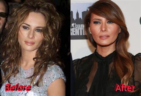 Melania Trump Plastic Surgery A First Botox Lady