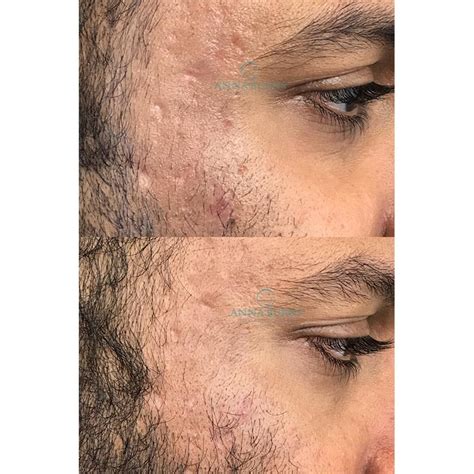Scar Revision Before And After Anna Burns Permanent Cosmetics